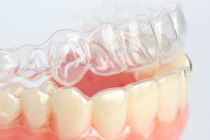 Invisalign Vs. Dental Crowns