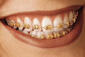 ladera ranch women wearing gold dynaflex braces