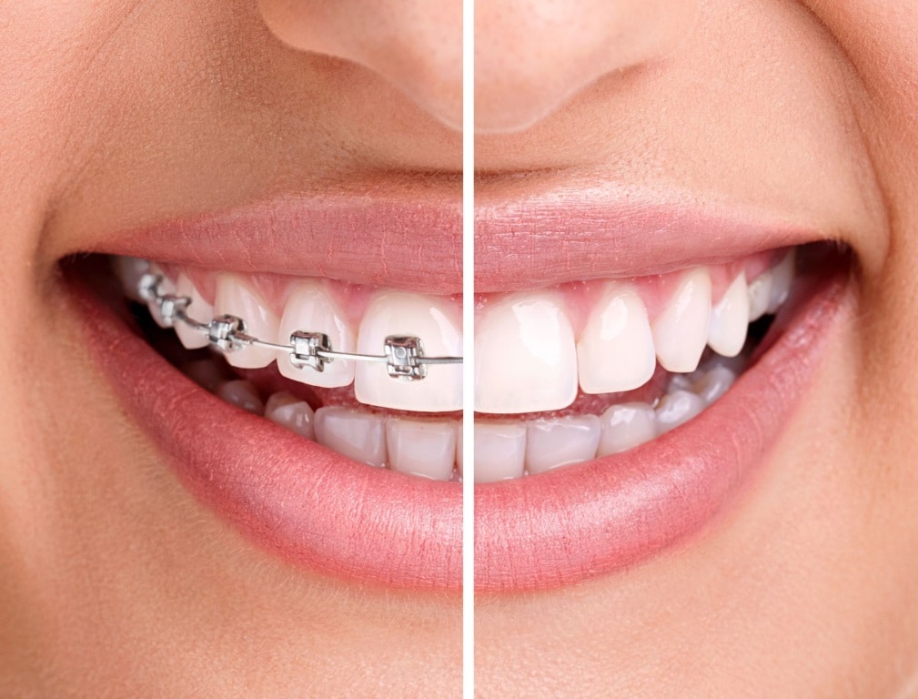 invisalign vs braces patient 